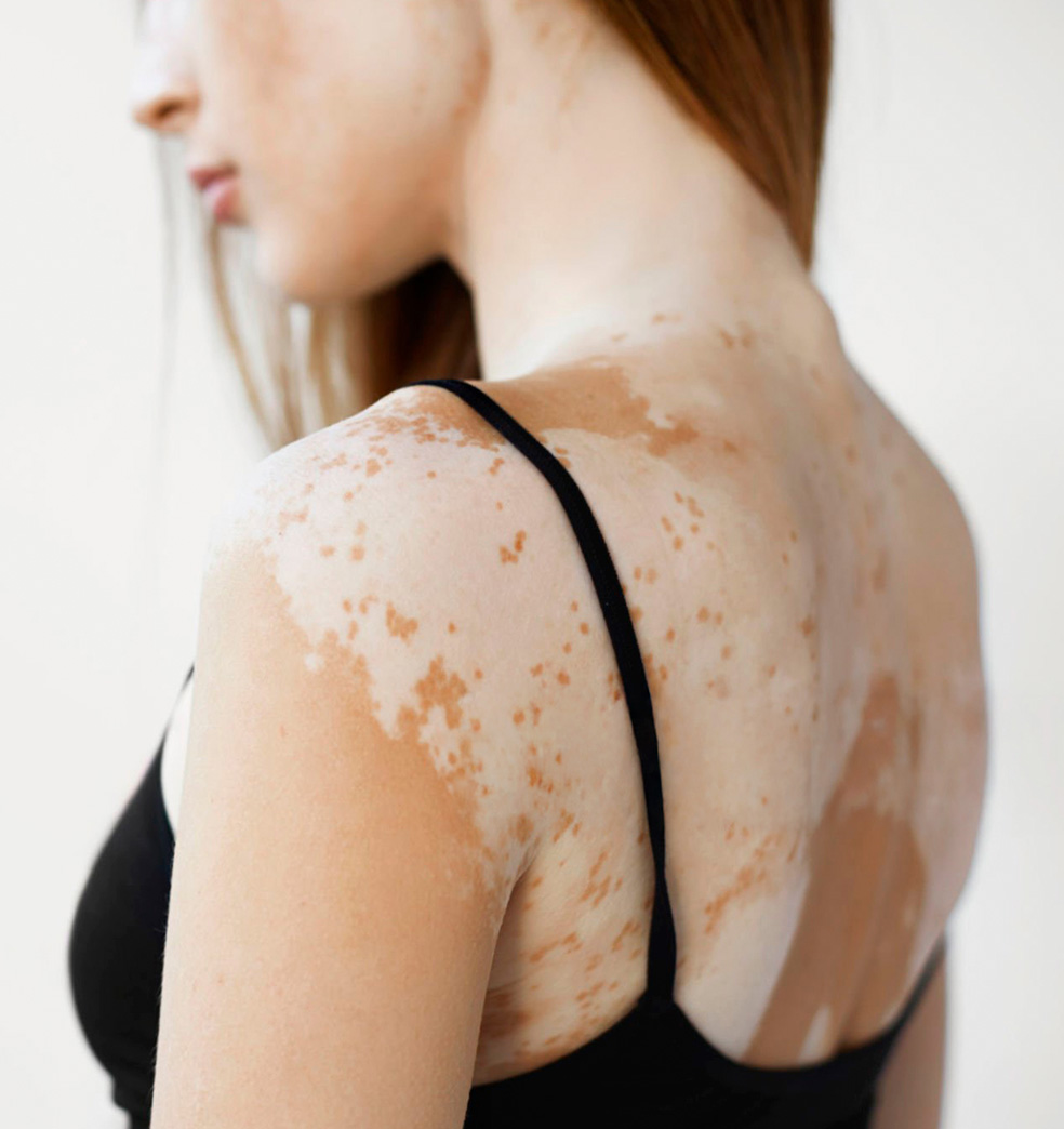 Aprendiendo sobre el vitiligo