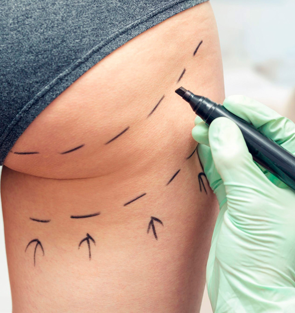 Aumento de gluteos: paso a paso