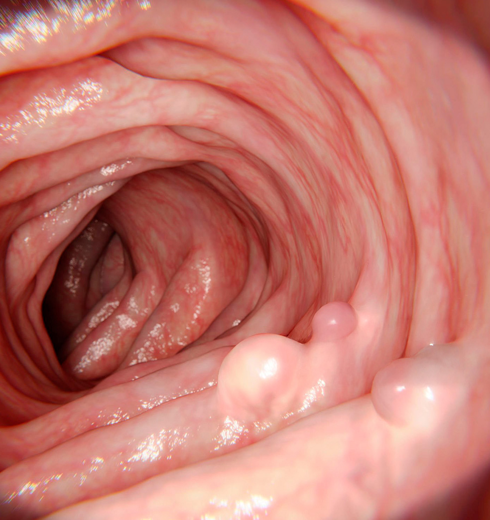 Detectar los pólipos para prevenir el cáncer de colon 