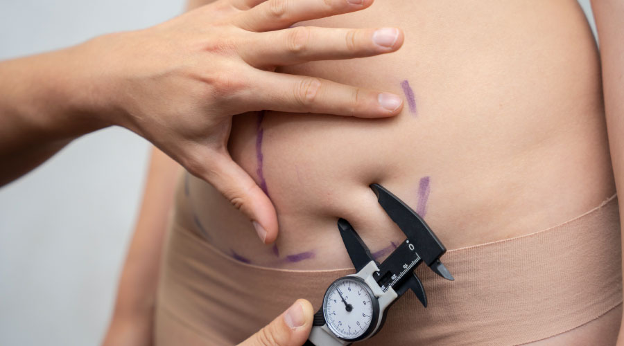 Cirugías de contorno corporal: Procedimientos para recuperar la figura tras grandes pérdidas de peso