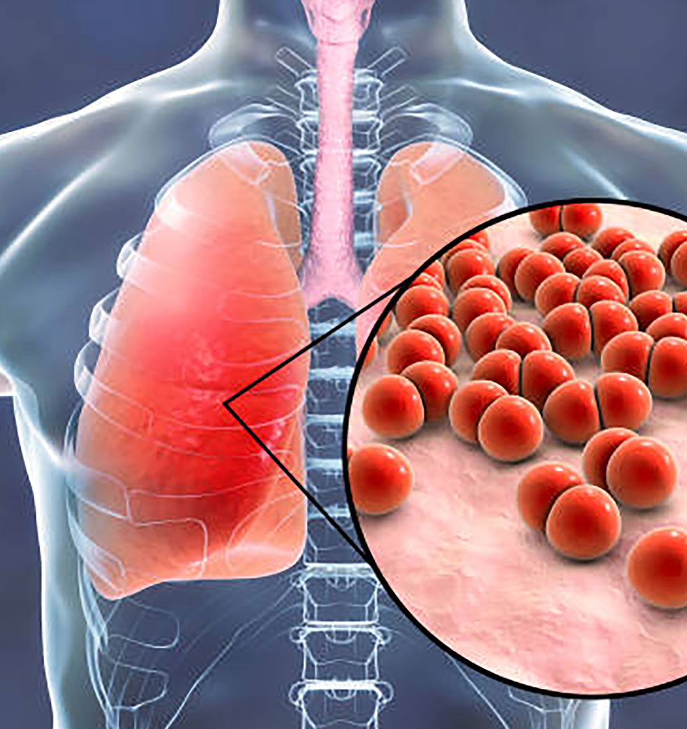 Cómo prevenir las infecciones por neumococo