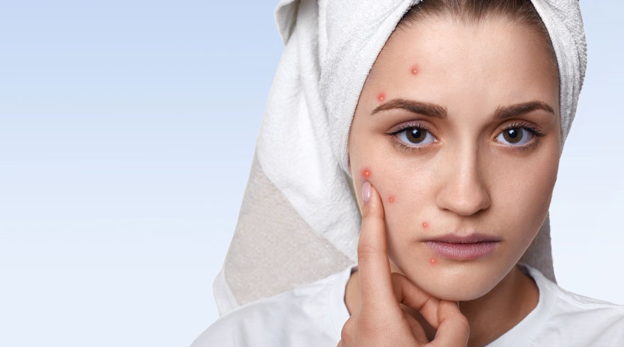 Las consecuencias que provocan las mascarillas en la piel