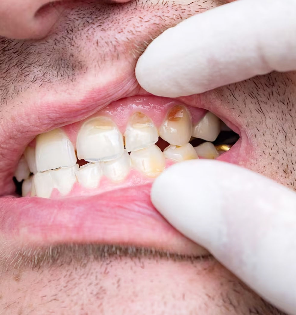 Contraindicaciones de los implantes dentales y cómo solucionarlas?