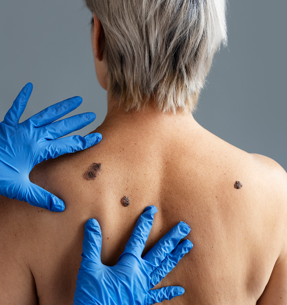 Todo sobre el Melanoma