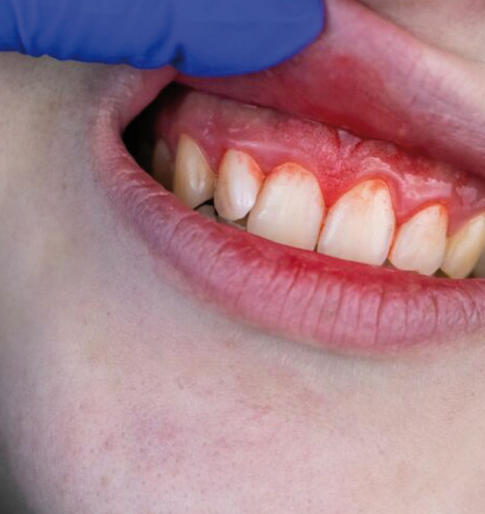 Las encías enfermas son un factor de riesgo para la salud?