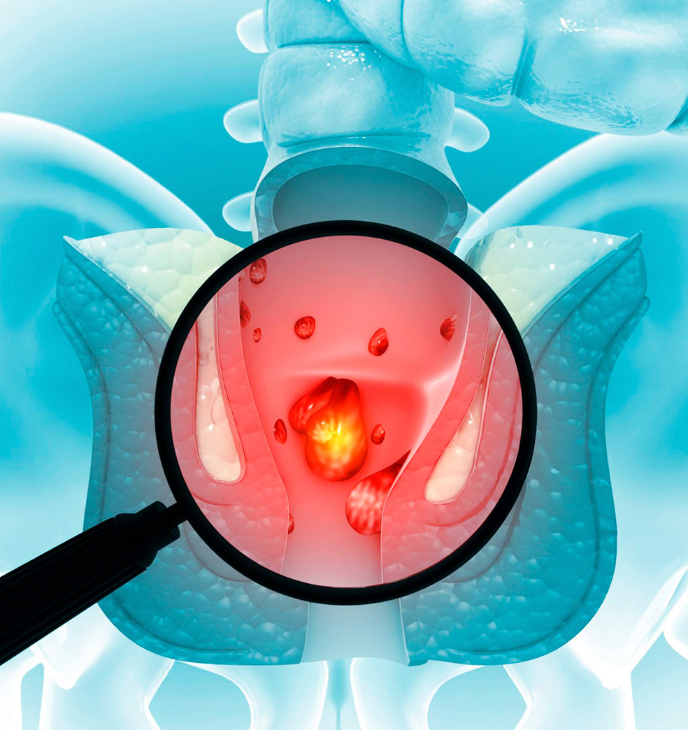 Enfermedad Hemorroidal