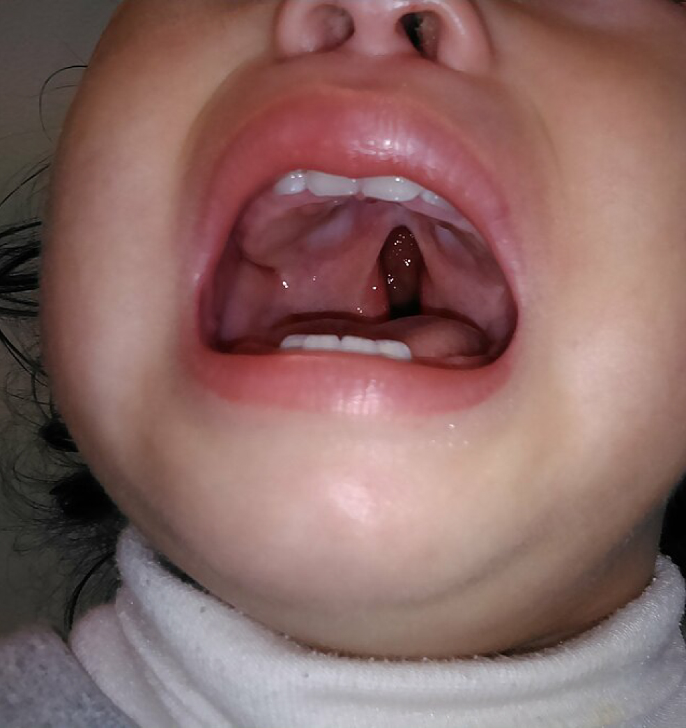 Tratamiento de los pacientes con fisuras de labio y paladar