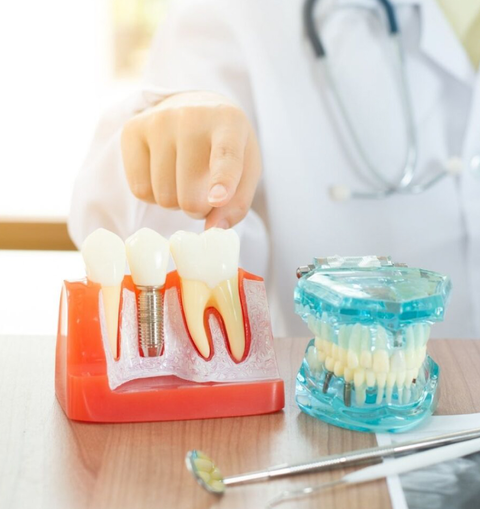 Los implantes dentales con carga inmediata