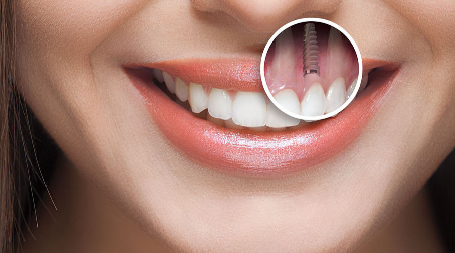 Materiales utilizados en la colocación de implantes dentales donde no hay hueso