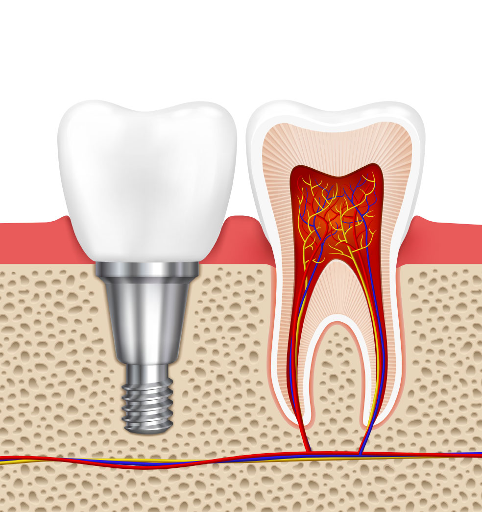 Implantes dentales: qué son y qué ventajas brindan