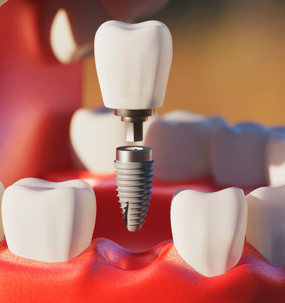 Implantes dentales: Indicaciones y contraindicaciones 