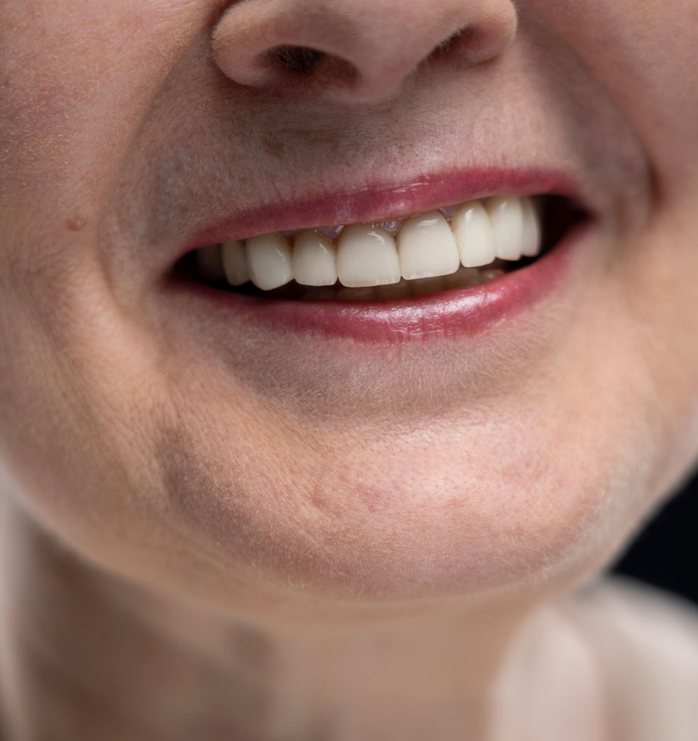 Los implantes monofásicos suizos