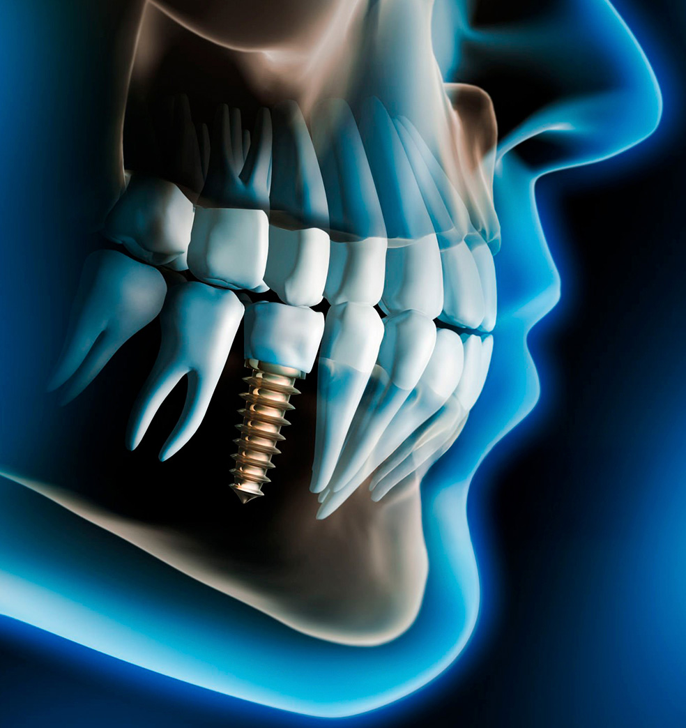 Implantología digital: Tecnología que restaura sonrisas  
