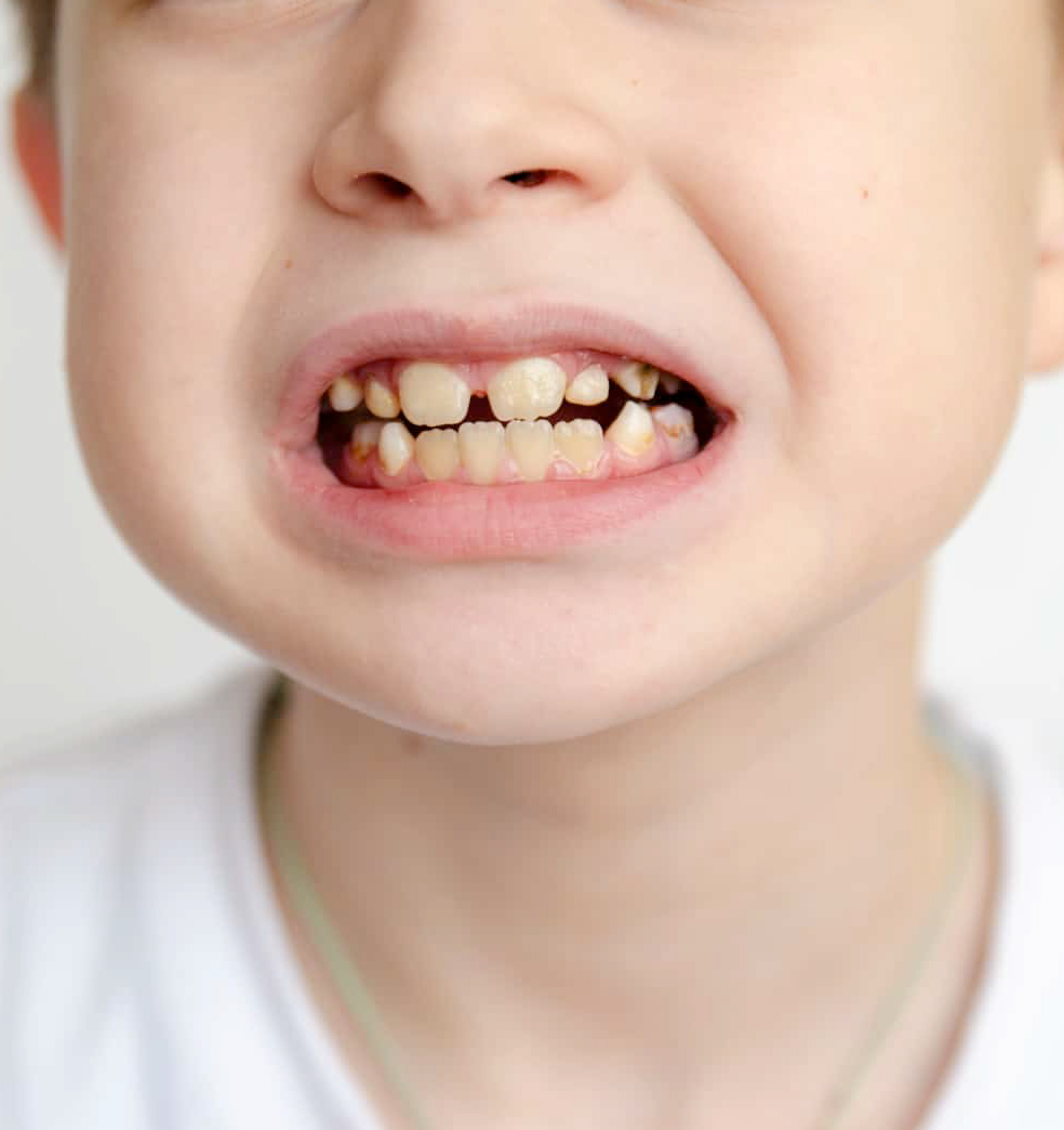 Manchas en los dientes: La hipoplasia dental en niños