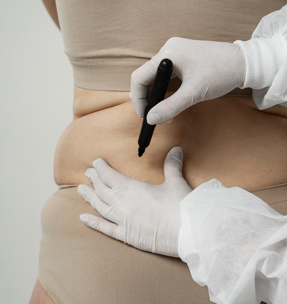 Diferencias entre Abdominoplastia y Liposuccion