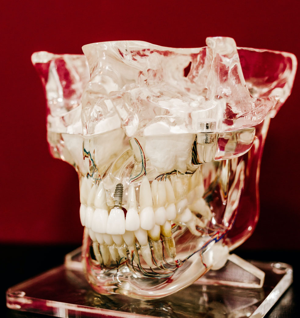 Los implantes dentales?