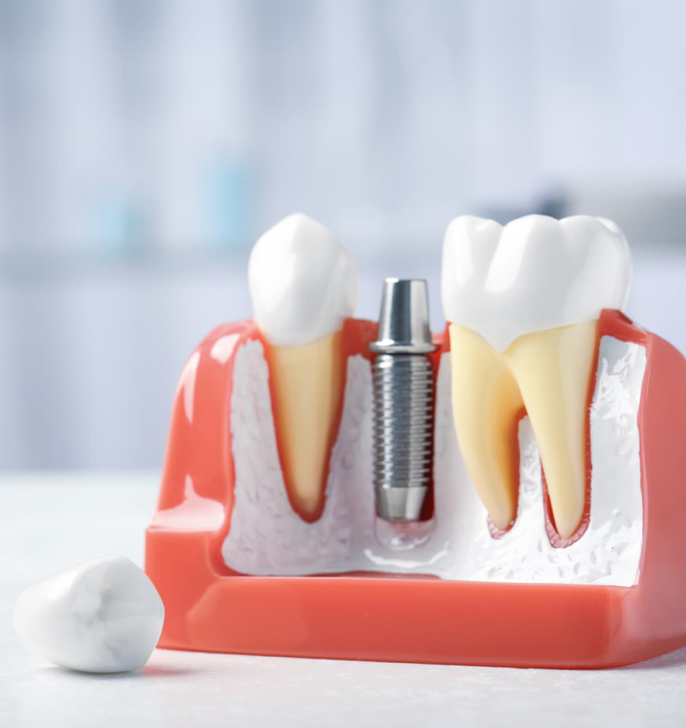 Los implantes dentales: La mejor opción para recuperar su sonrisa