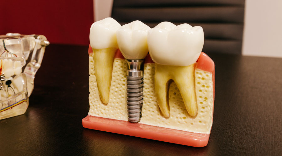 Los implantes dentales