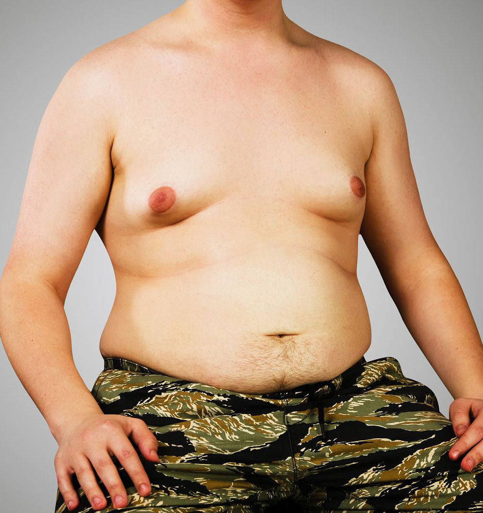 Cirugía de mamas masculinas?