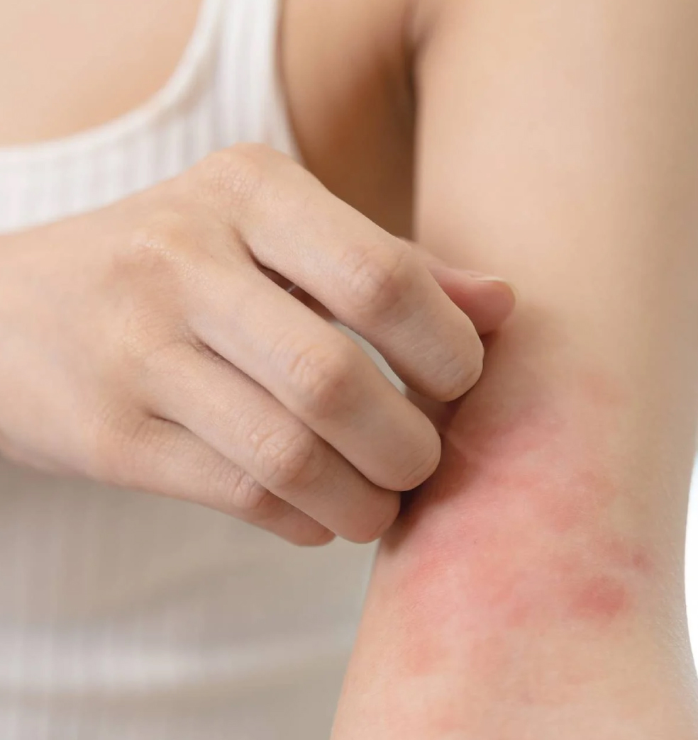 Cómo se manifiesta la dermatitis atópica