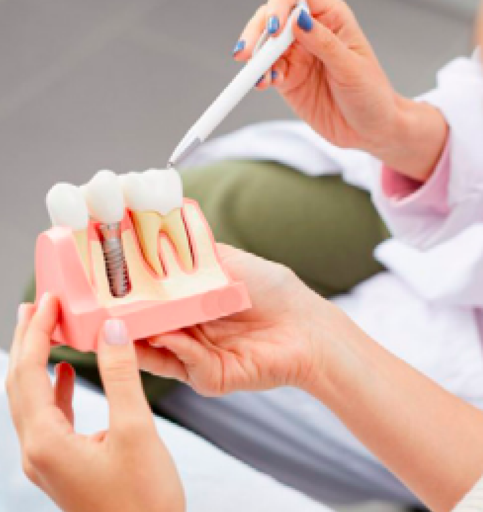 Mitos y verdades sobre los implantes dentales