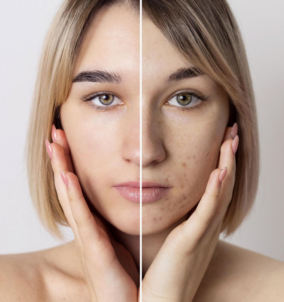 El peeling químico?