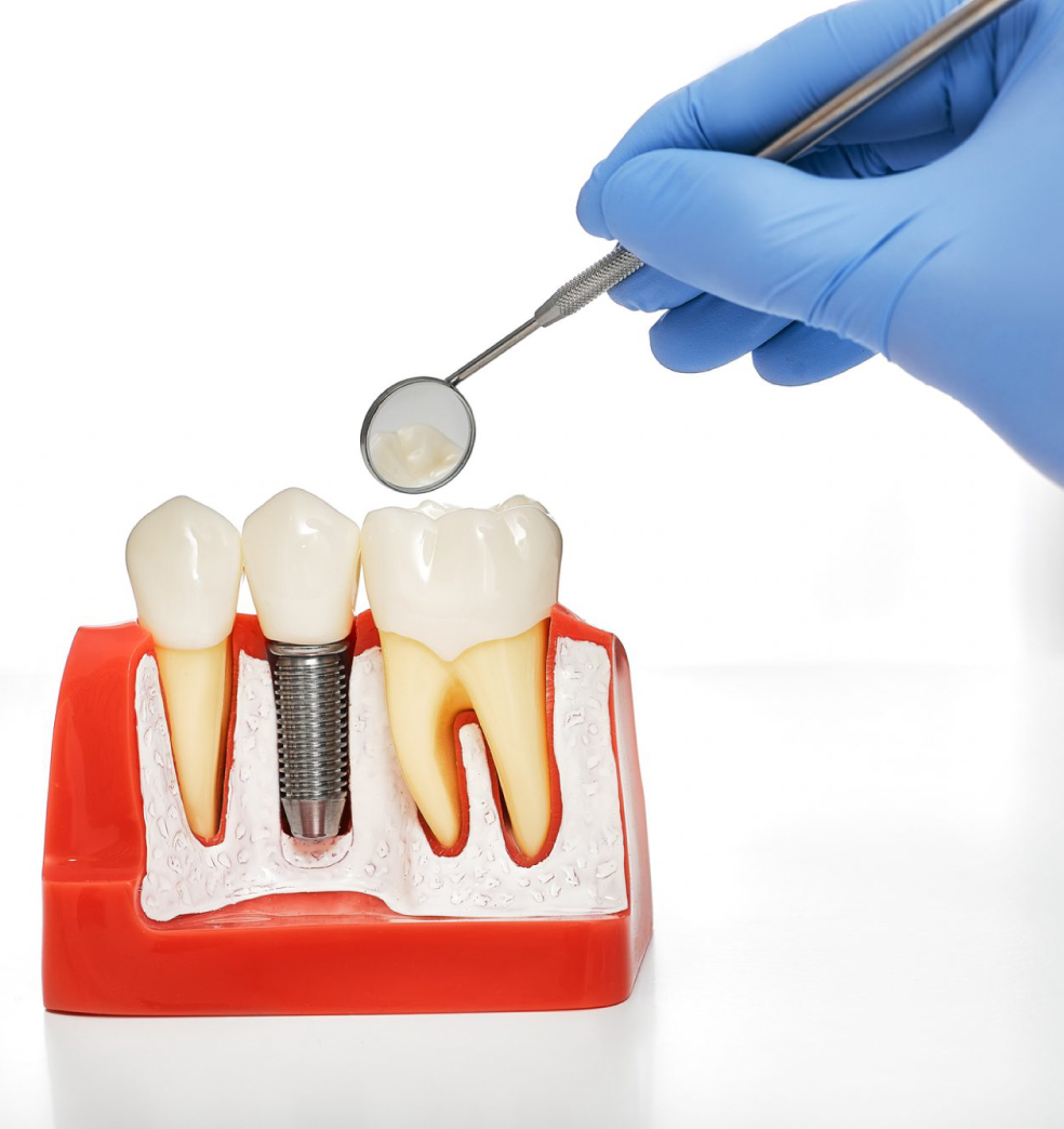 ¿Por qué los implantes dentales son la primera opción de rehabilitación dental?