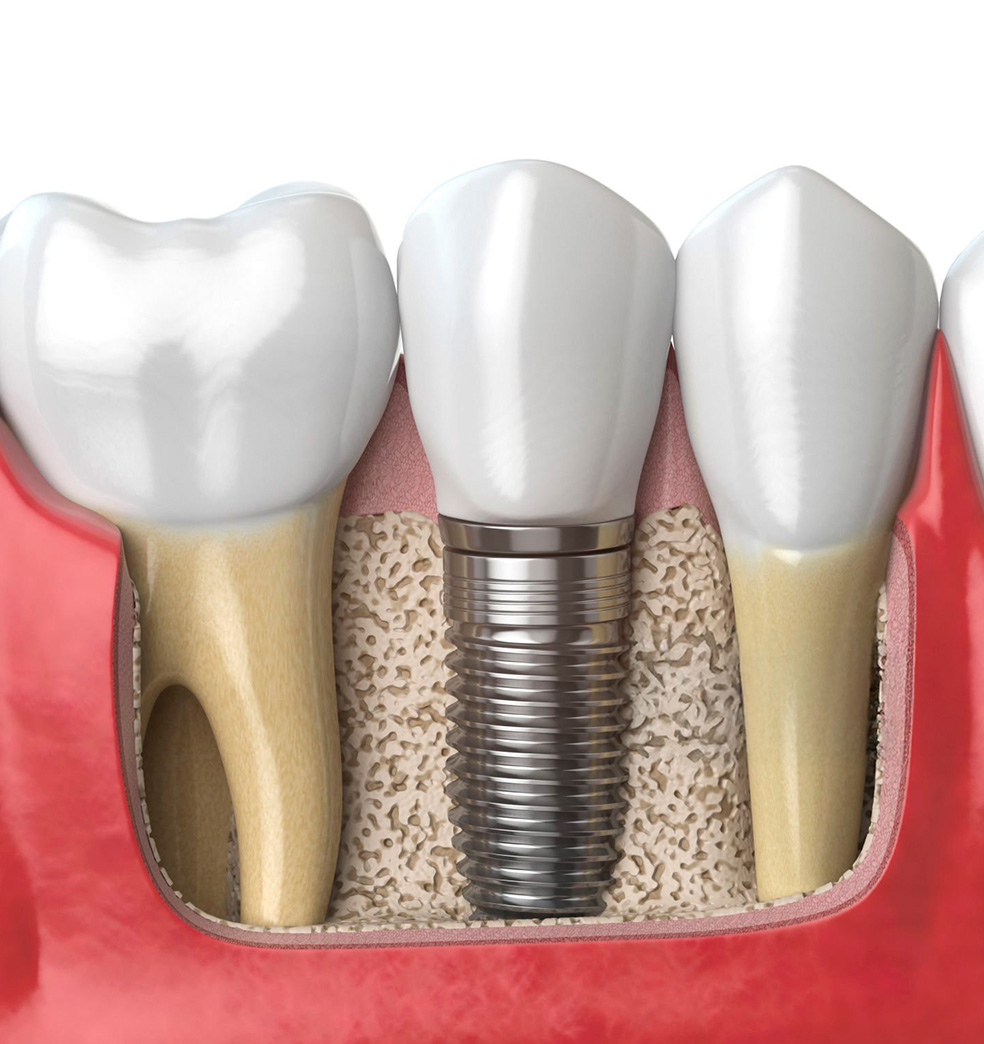 Preguntas frecuentes sobre los implantes dentales