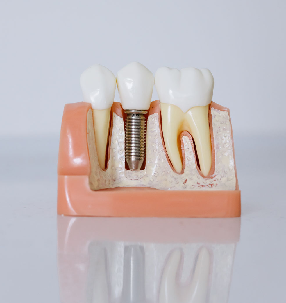 Qué es mejor: ¿Implantes o prótesis dentales?