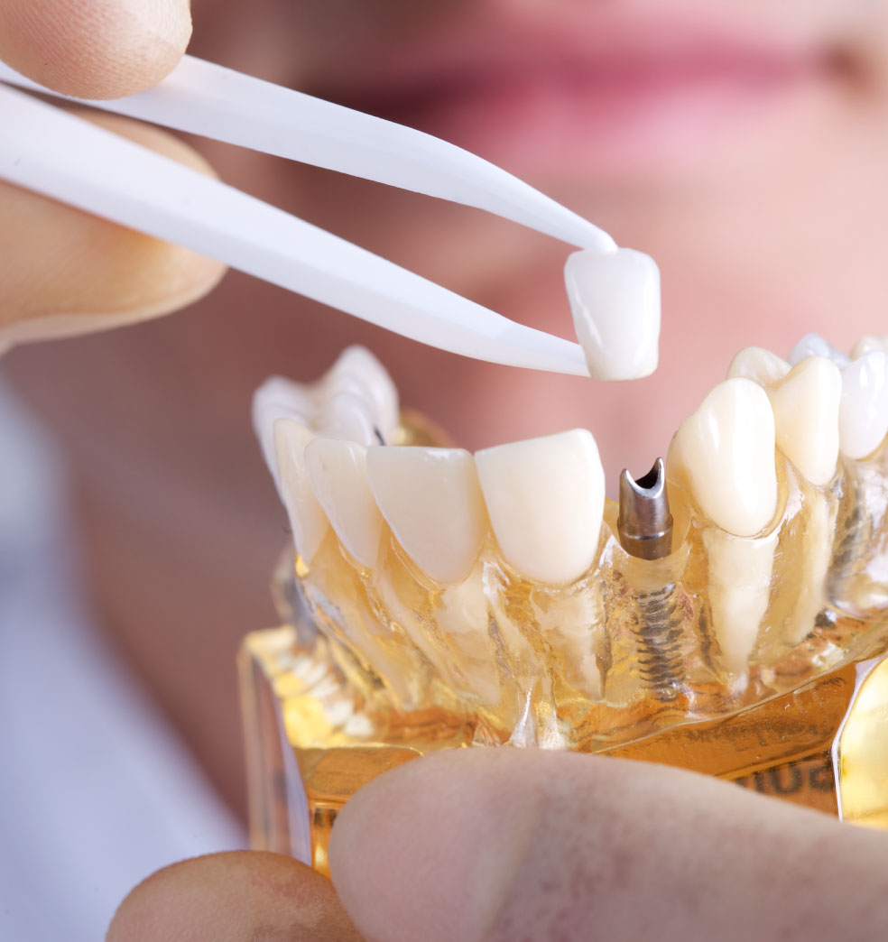 Qué son los implantes dentales y qué ventajas brindan?