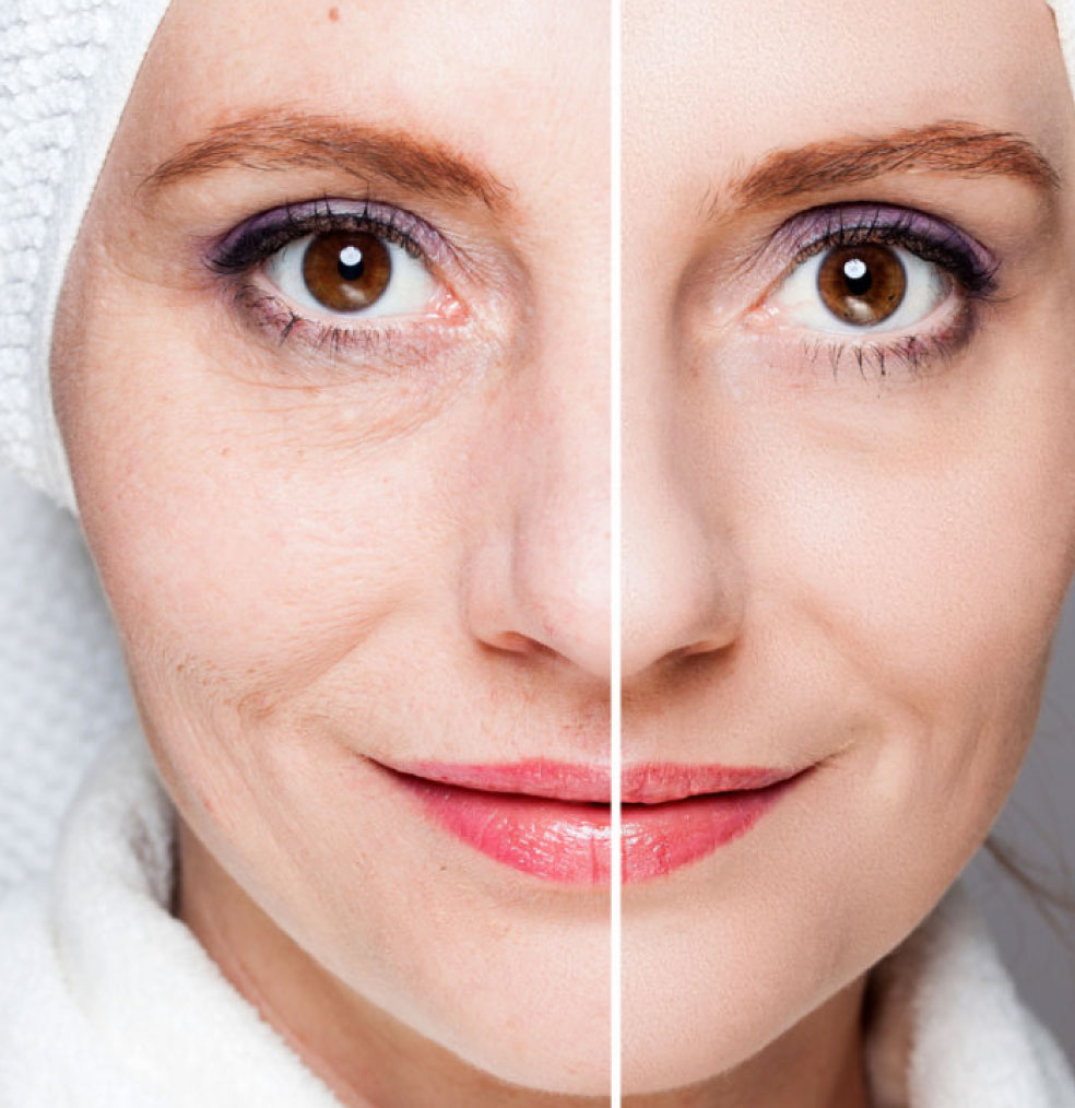 Procedimientos para el rejuvenecimiento facial 