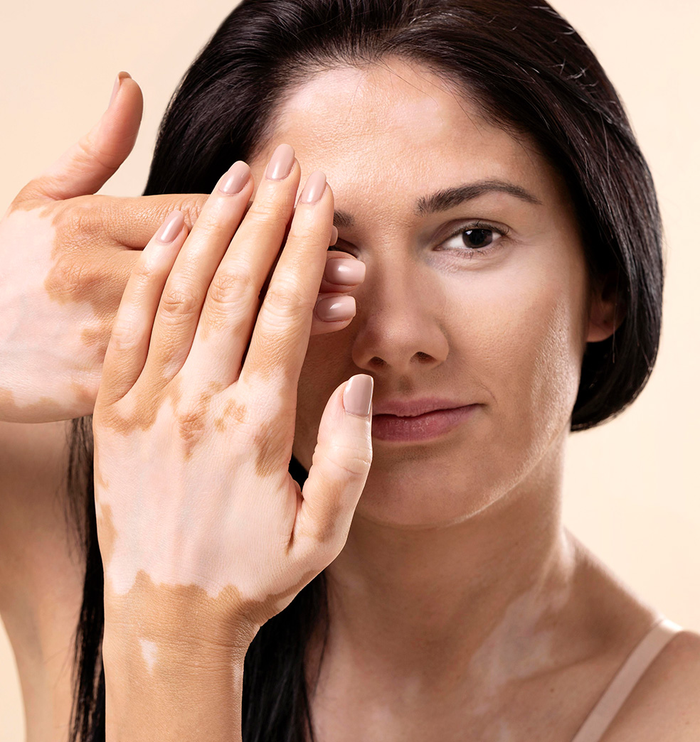 Todo sobre el vitiligo
