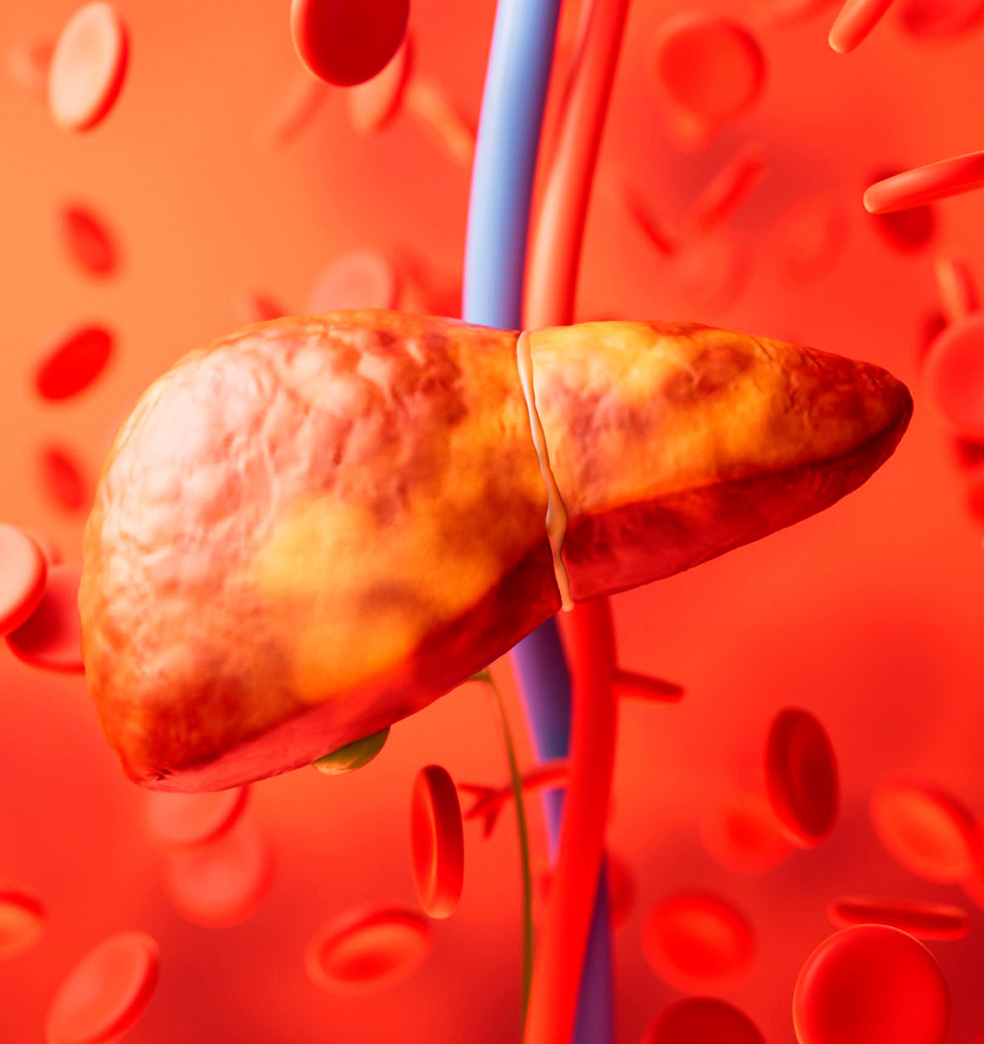 Todo sobre el higado graso