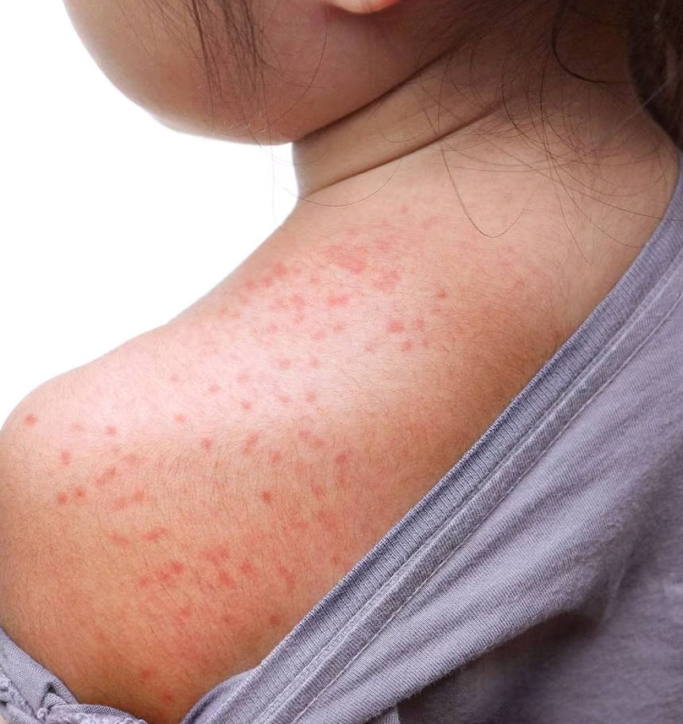 Todo sobre sarampión?