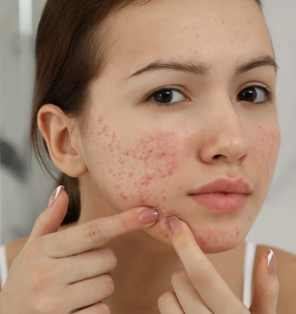 Tratamientos del acné juvenil?