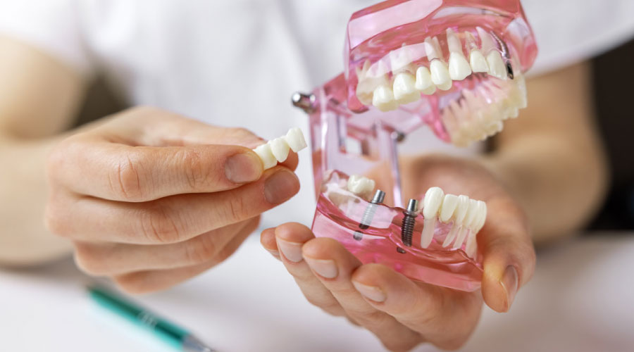 Ventajas y desventajas de los implantes dentales bifásicos y monofásicos