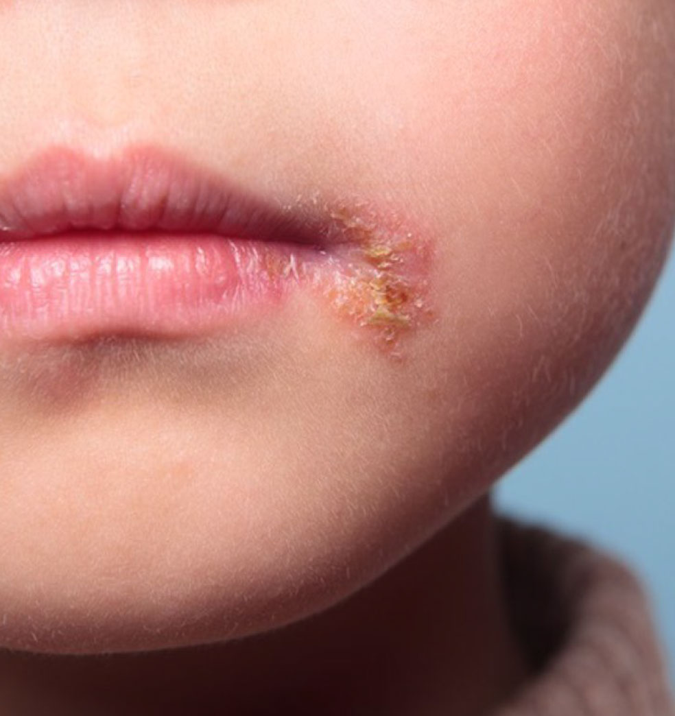 Infección por el virus del herpes